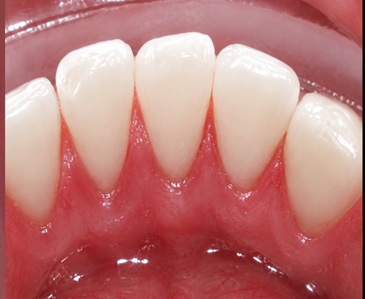 Depois da limpeza dental
