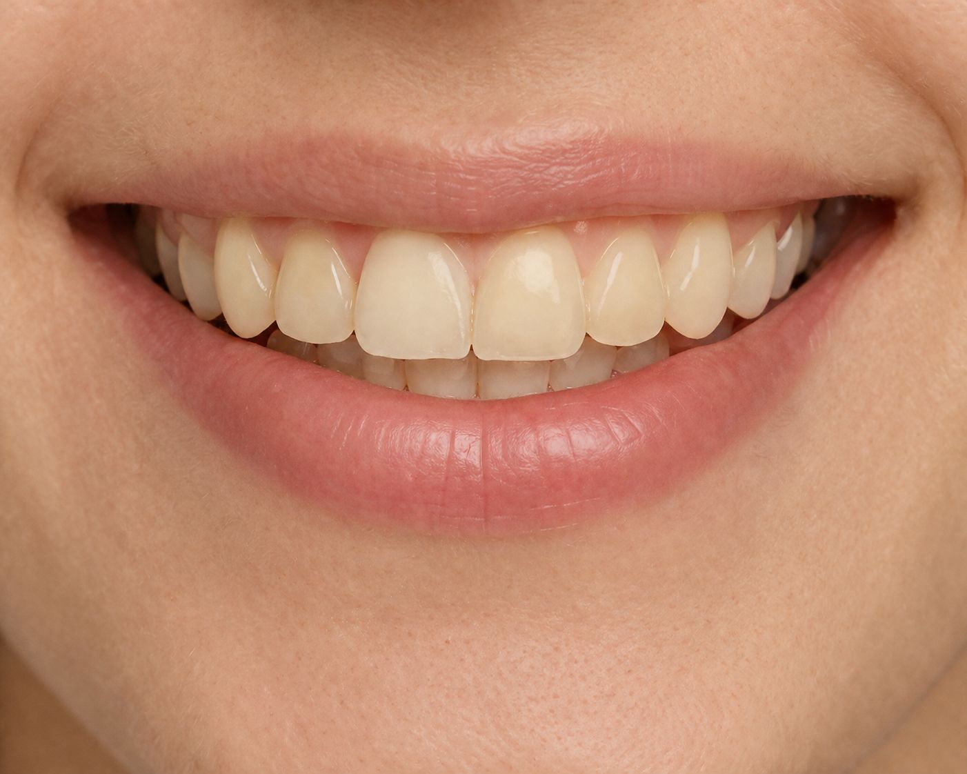 Antes do clareamento dental